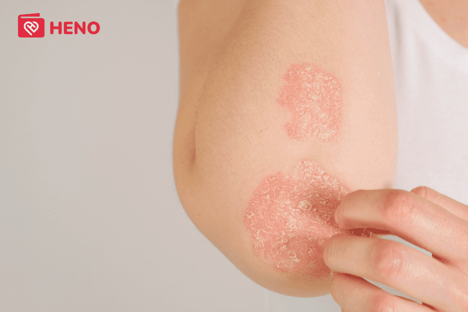 5 bệnh về da thường gặp trong mùa hè và cách phòng tránh